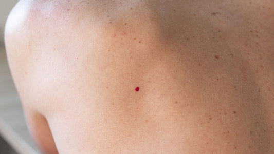 Cherry Angiomas & Castor Oil: Can Nature Help Fade Those Red Spots?