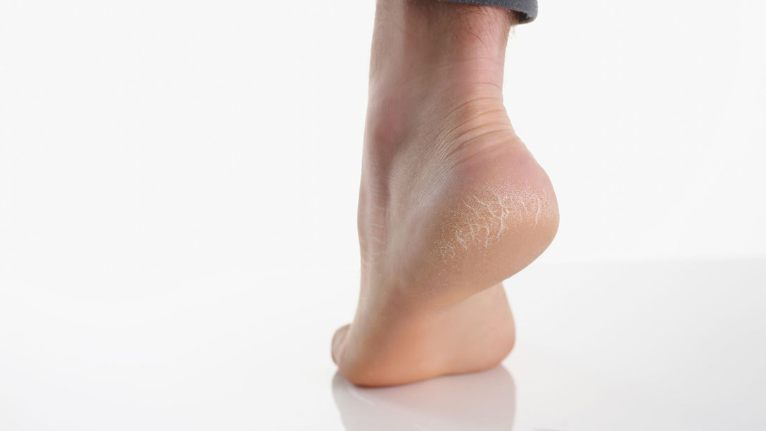 How to Use Castor Oil on Cracked Heels: A Simple Guide to Smooth, Healthy Feet
