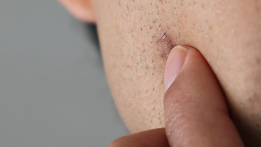 How Castor Oil Can Help with Ingrown Hairs