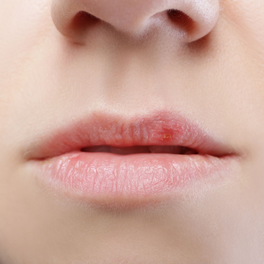 Castor Oil for Cold Sores