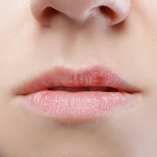 Castor Oil for Cold Sores