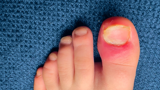 How Castor Oil Can Help with Ingrown Nails: The Natural Relief You’ve Been Looking For!