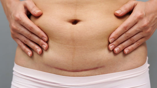 How Castor Oil Can Help Prevent Internal Scar Tissue After Abdominal Surgery