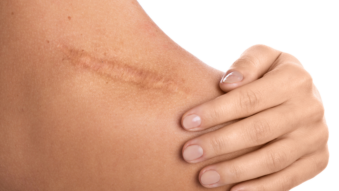 Castor Oil for Wound Care & Skin Healing